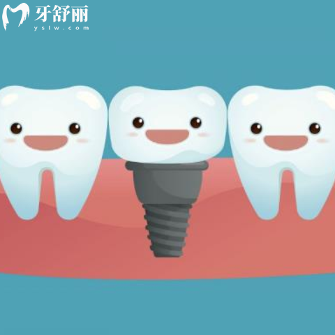 以色列abt种植牙怎么样?五级纯钛材质质量好中高端档次价格合理不是杂牌
