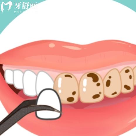 牙贴面树脂的好还是瓷贴面好?从优点和缺点/价格区别了解下