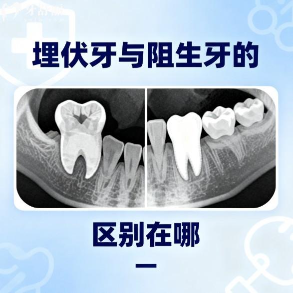 埋伏牙与阻生牙的区别在哪?还有相对应的治疗方案及术后注意事项分享