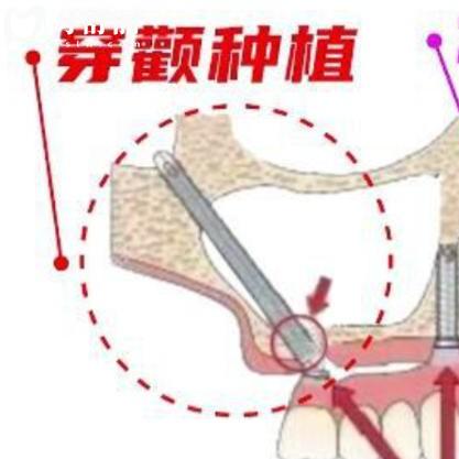 穿翼板种植牙技术成熟吗？这项\“无土栽培\“种牙新技术真实解读