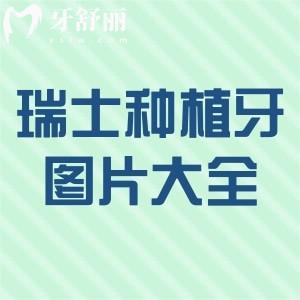 瑞士种植牙图片大全分享!一文带你了解瑞士种植牙品牌及材料价格表