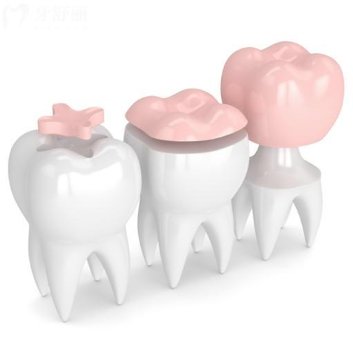 根管治疗后戴的牙套能用多久?做好这几点能用很多年