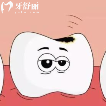 嘴巴里4颗蛀牙怎么办?来看看如何治疗比较好