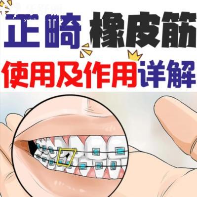 正畸橡皮圈是干嘛用的?详解矫正皮筋的分类与戴法