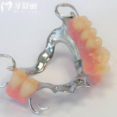 维他灵支架到底是什么材质：揭秘口腔修复界的“多才多艺选手”材质之谜