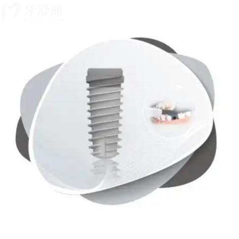 大清西格和奥齿泰种植体怎么选？一文看懂优缺点与适用场景