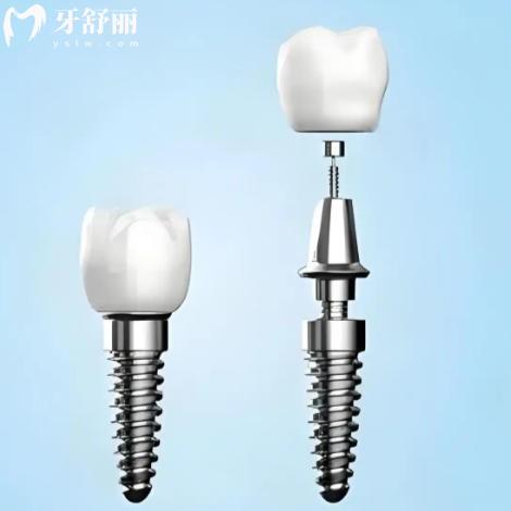 瑞士SIC和ITI种植体哪个好？同是瑞士品牌区别大吗如何选择