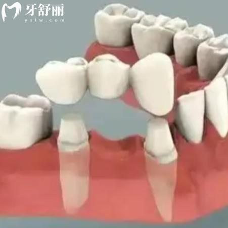 威兰德臻瓷VS全瓷：口腔修复材料怎么选？一文读懂差异