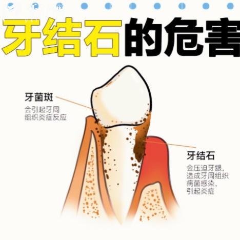 牙结石能自己抠掉吗？并不建议，盲目操作风险大！