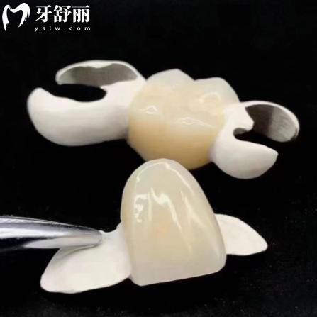 想做修复的牙友注意了，粘结桥修复贵吗？耐用吗？费用与寿命全解析