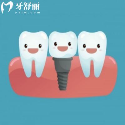26西宁中诺口腔价格表上新:韩系/欧美不同种植体价格不同