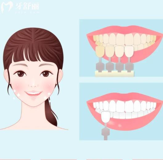 牙齿美白能提升几个色阶？科学解析让你明明白白美容