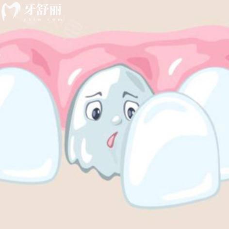 牙贴面好处和坏处解读：你想知道的利弊都在这