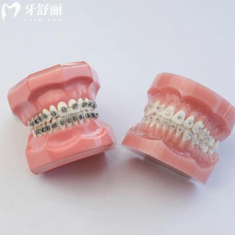 陶瓷自锁托槽哪个品牌好？从材质、舒适度到结果，多方面比较