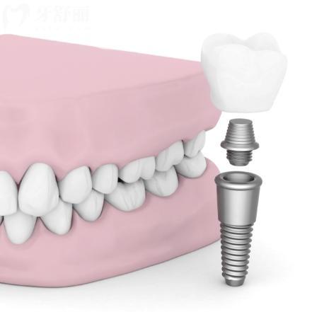 国产创英种植牙与进口种植牙区别是什么？核心差异很简单