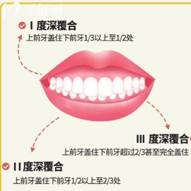 闭锁性深覆合矫正难治吗？从定义矫正过程多多方面解答